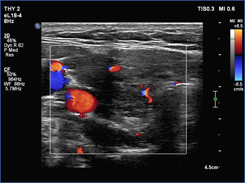 Right lobe, longitudinal scan