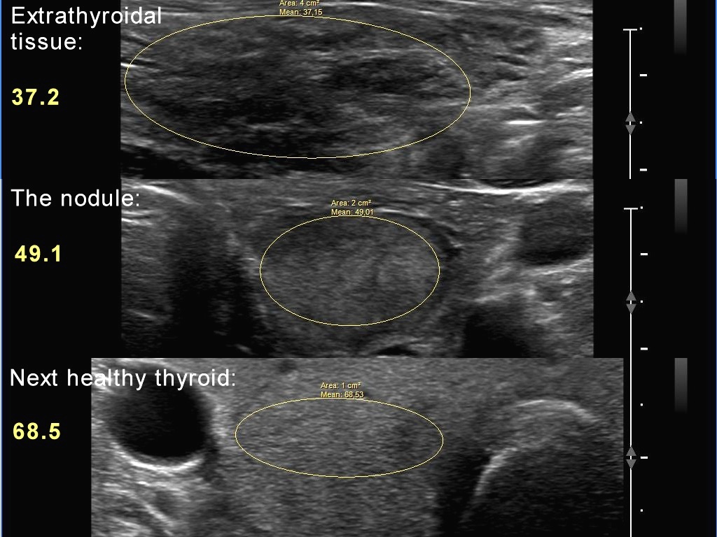 Right lobe, longitudinal scan