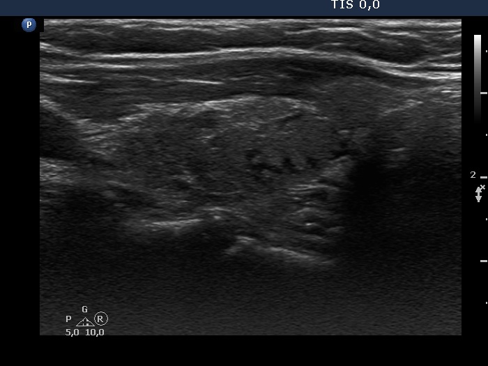 Right lobe, longitudinal scan
