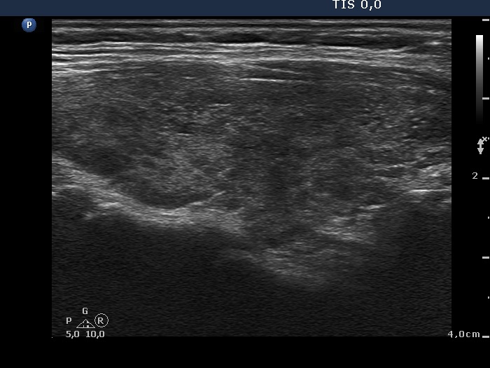 Right lobe, longitudinal scan