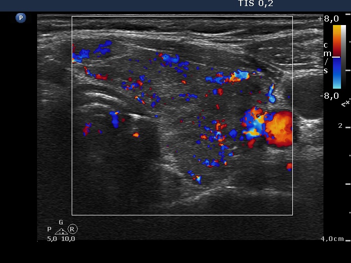 Right lobe, longitudinal scan