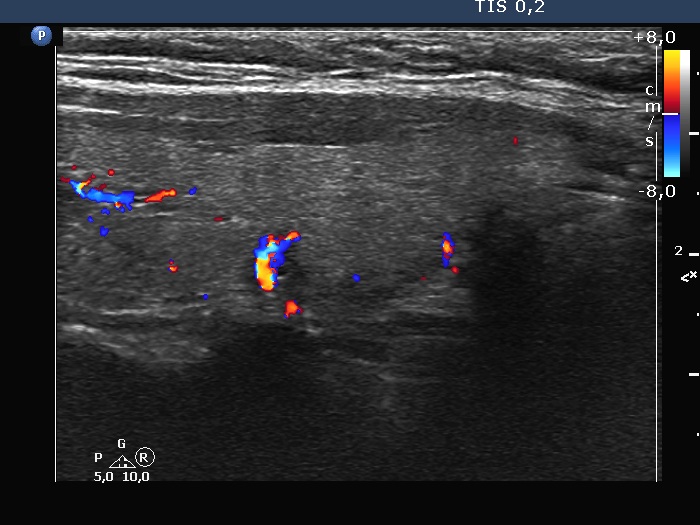 Right lobe, longitudinal scan