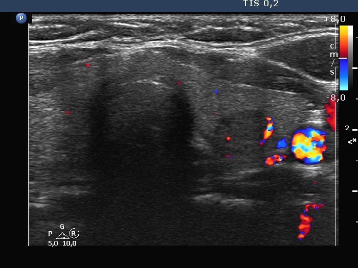 Right lobe, longitudinal scan