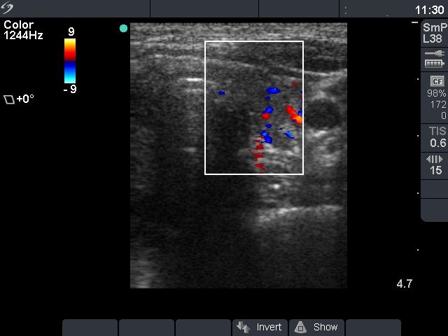 Right lobe, longitudinal scan