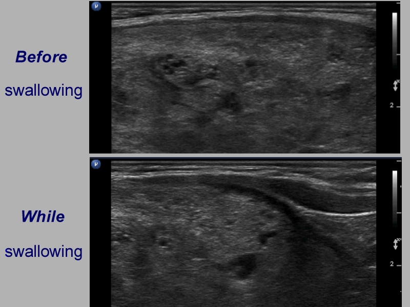 Right lobe, longitudinal scan