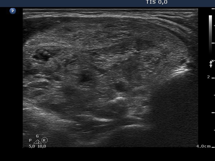Right lobe, longitudinal scan