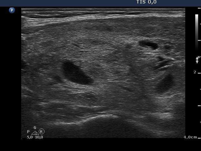 Right lobe, longitudinal scan