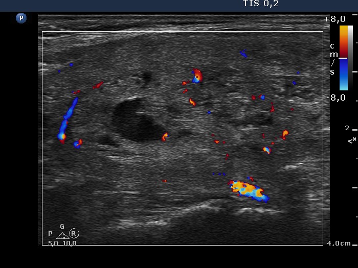 Right lobe, longitudinal scan
