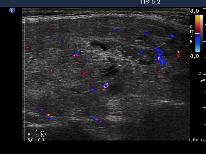Right lobe, longitudinal scan
