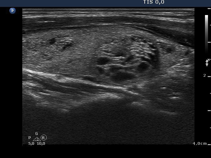 Right lobe, longitudinal scan