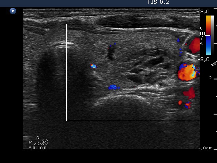 Right lobe, longitudinal scan