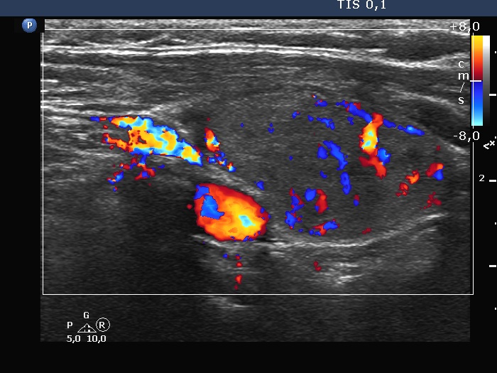 Right lobe, longitudinal scan