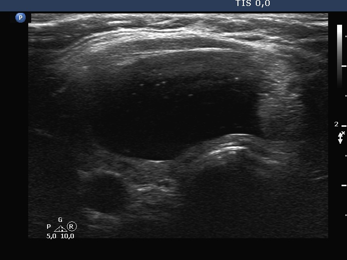 Right lobe, longitudinal scan