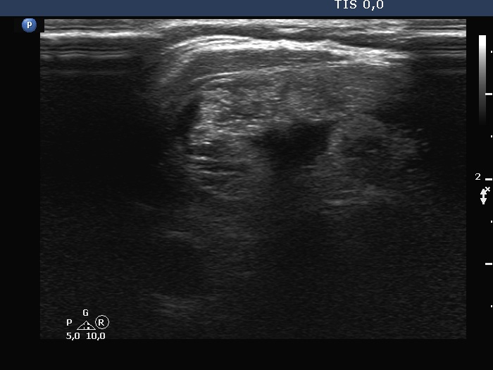 Right lobe, longitudinal scan