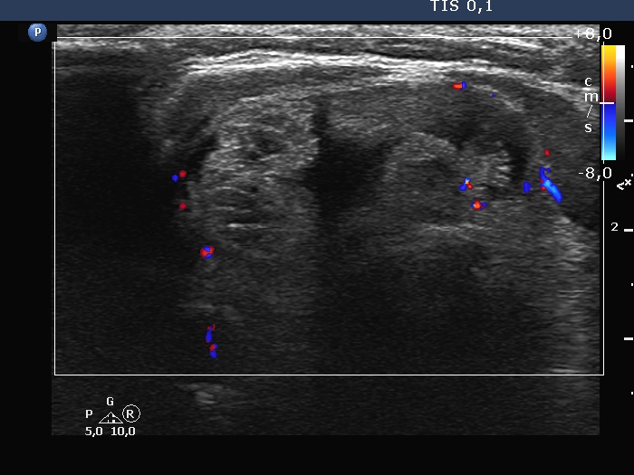 Right lobe, longitudinal scan