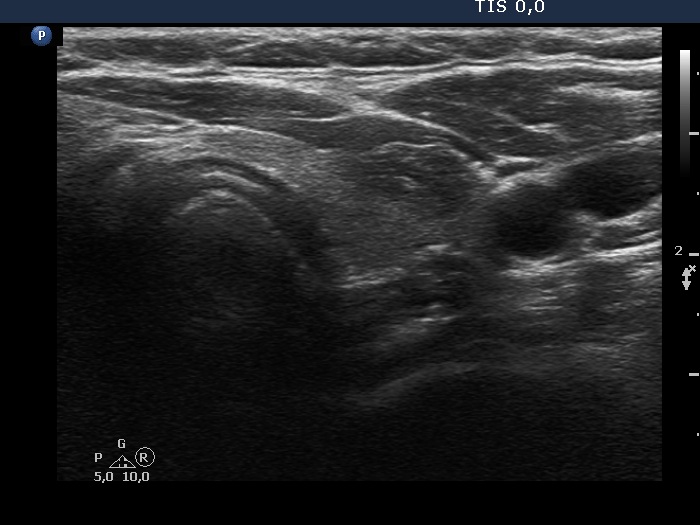Right lobe, longitudinal scan
