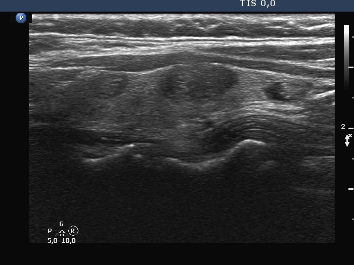 Right lobe, longitudinal scan