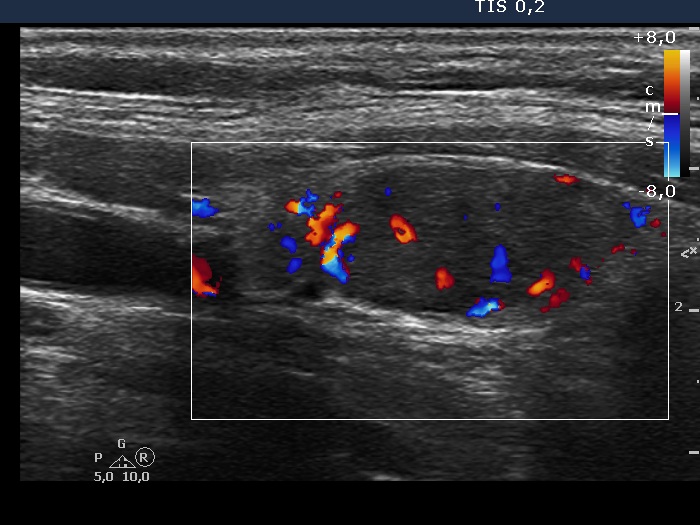 Right lobe, longitudinal scan