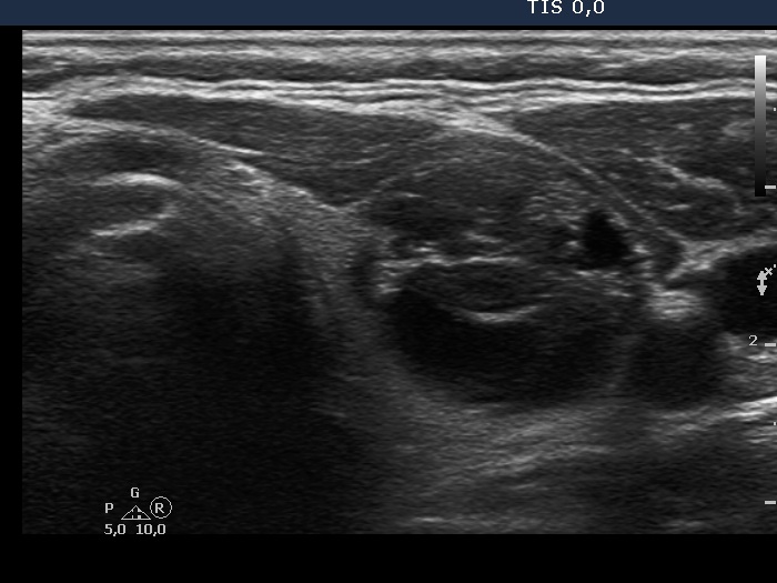 Right lobe, longitudinal scan