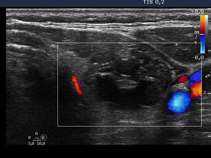 Right lobe, longitudinal scan