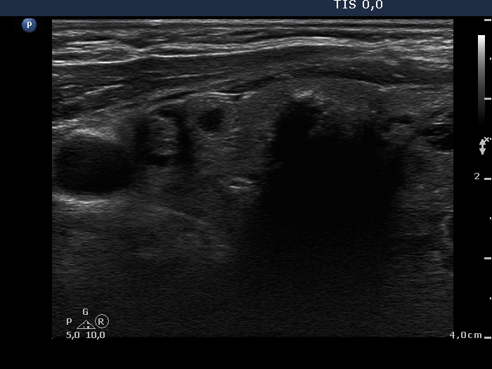 Right lobe, longitudinal scan