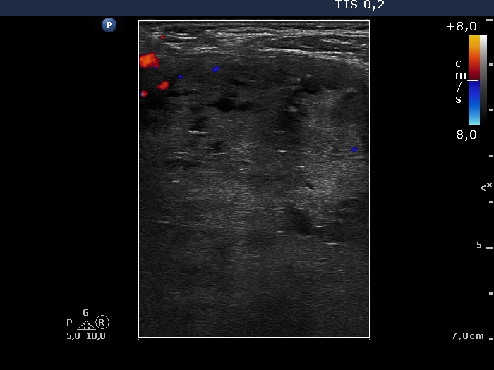 Right lobe, longitudinal scan