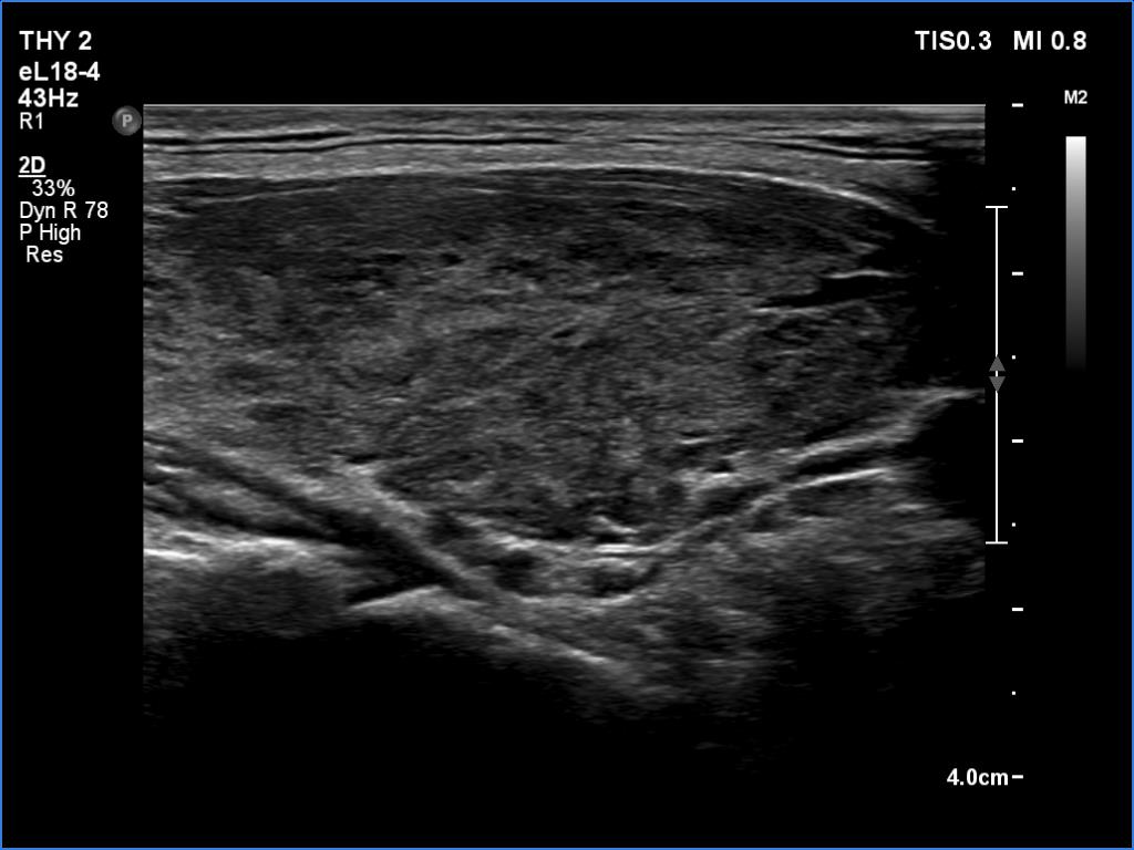 Right lobe, longitudinal scan