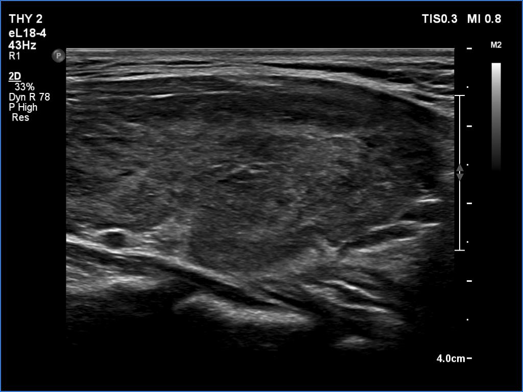 Right lobe, longitudinal scan