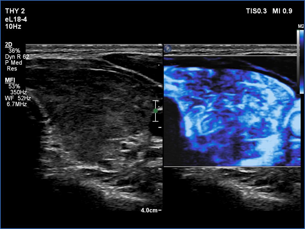 Right lobe, longitudinal scan