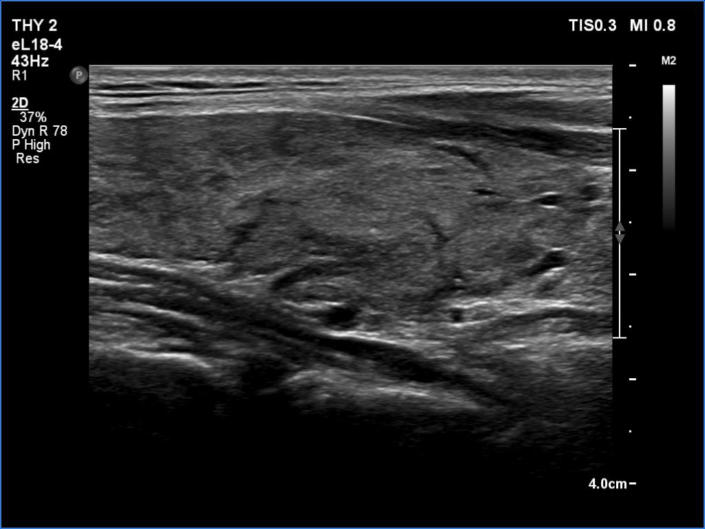 Right lobe, longitudinal scan