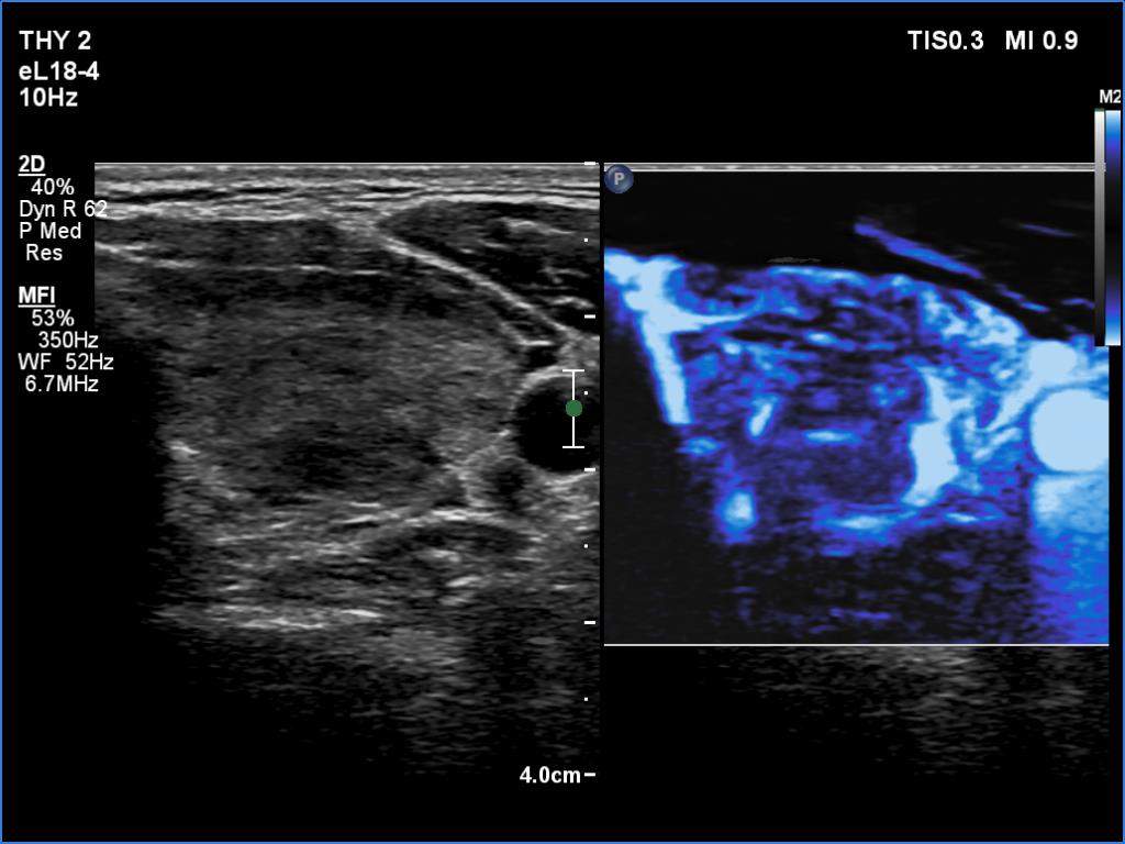 Right lobe, longitudinal scan