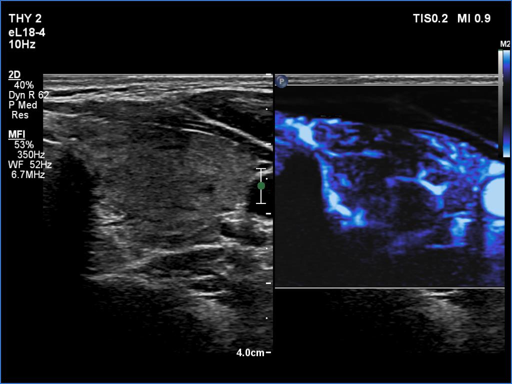 Right lobe, longitudinal scan
