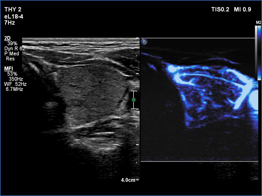 Right lobe, longitudinal scan
