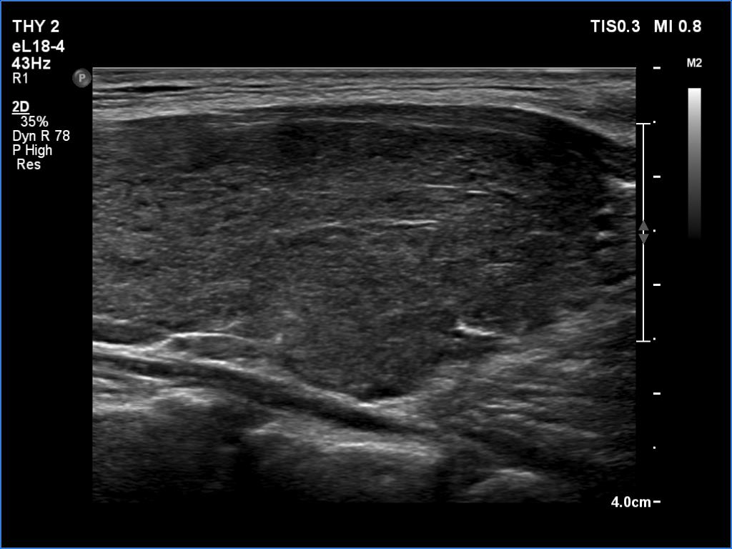 Right lobe, longitudinal scan