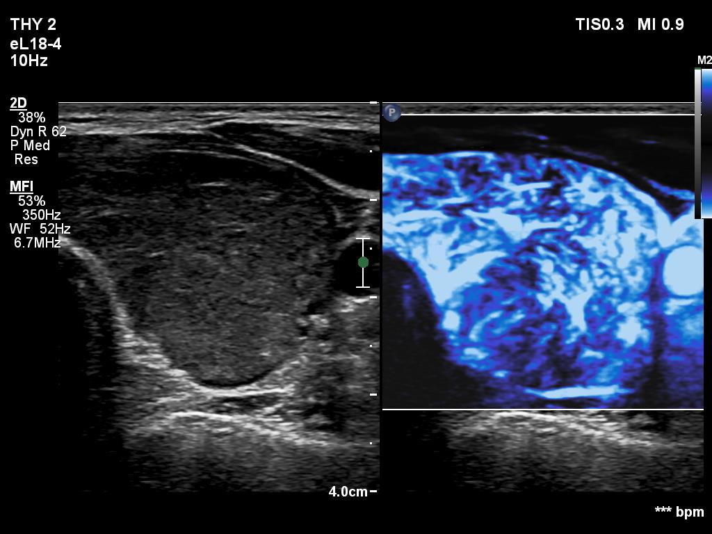 Right lobe, longitudinal scan