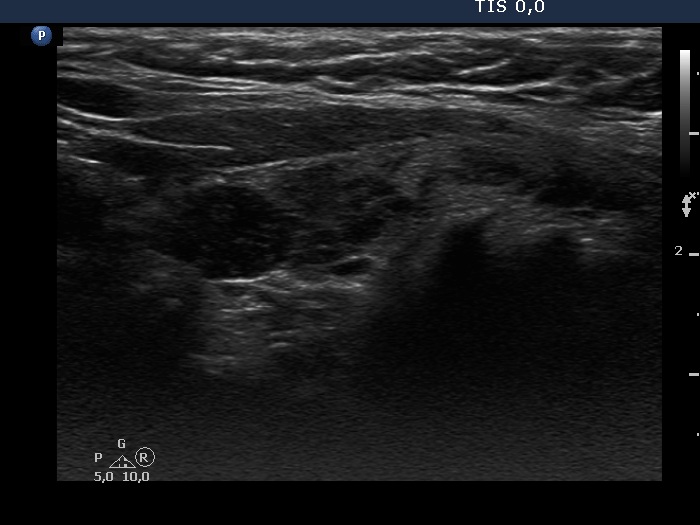 Right lobe, longitudinal scan