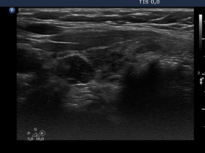 Right lobe, longitudinal scan