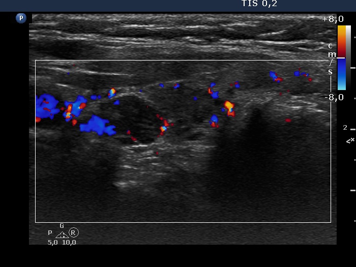 Right lobe, longitudinal scan