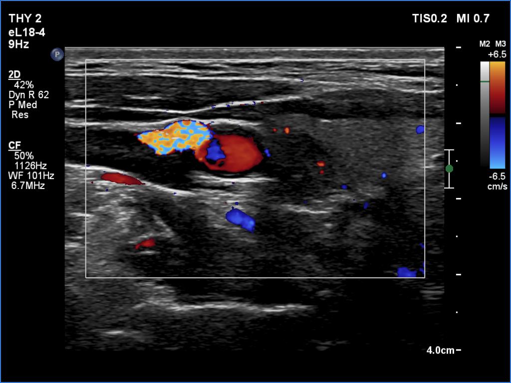 Right lobe, longitudinal scan