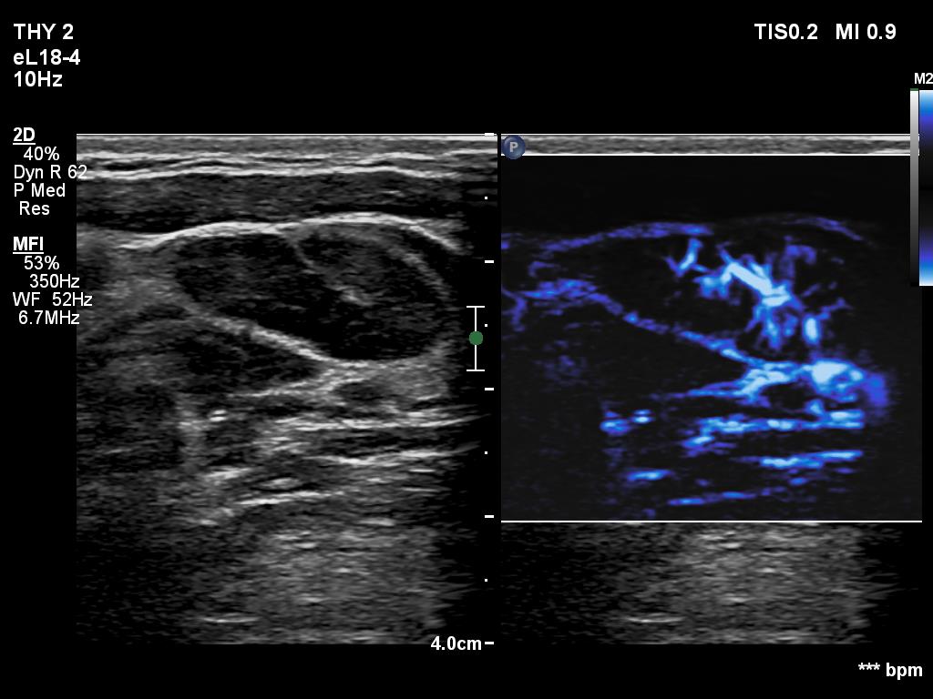 Right lobe, longitudinal scan