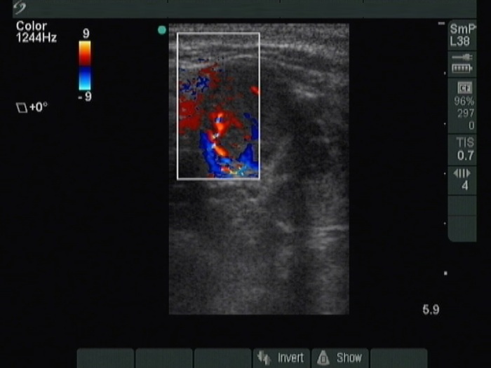 Right lobe, longitudinal scan