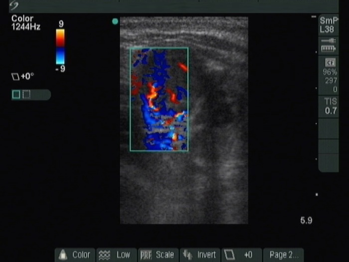 Right lobe, longitudinal scan