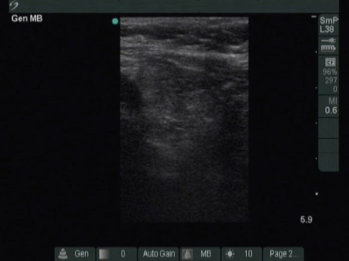 Right lobe, longitudinal scan
