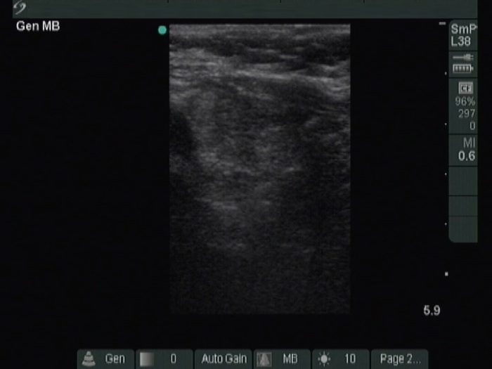Right lobe, longitudinal scan