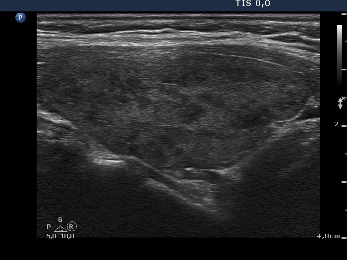 Right lobe, longitudinal scan