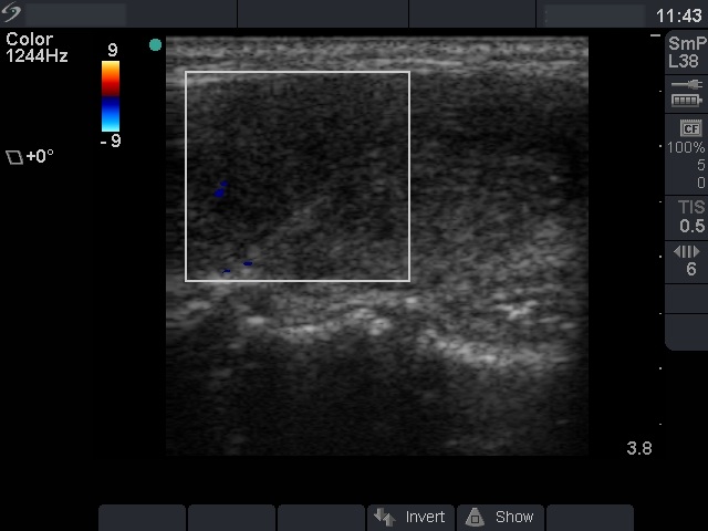 Right lobe, longitudinal scan