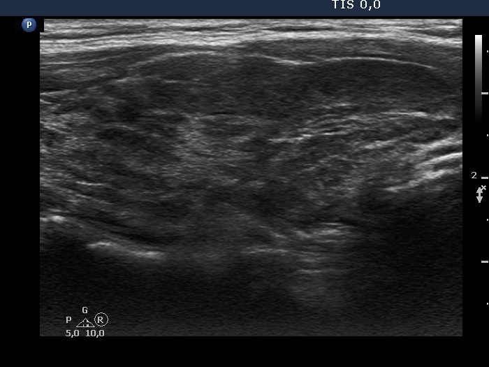 Right lobe, longitudinal scan