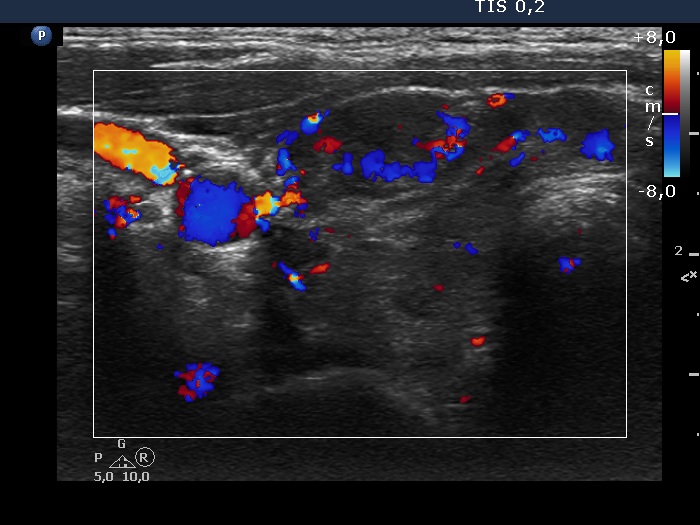 Right lobe, longitudinal scan
