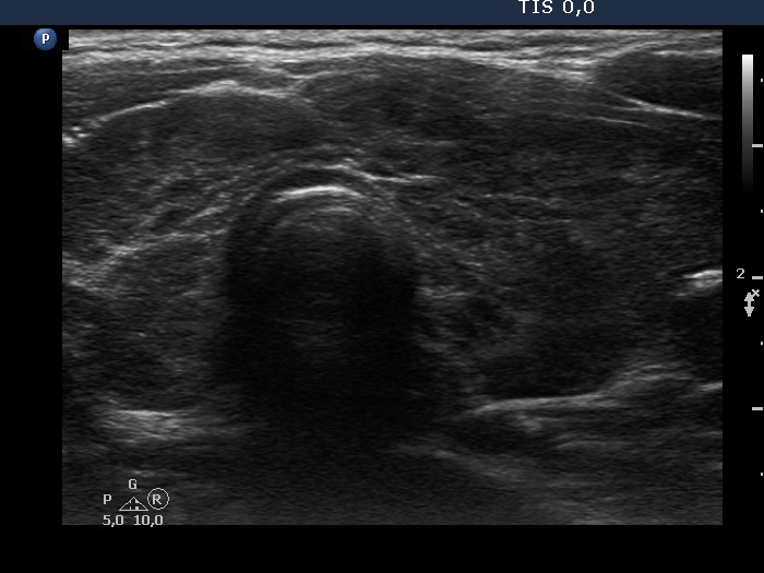 Right lobe, longitudinal scan