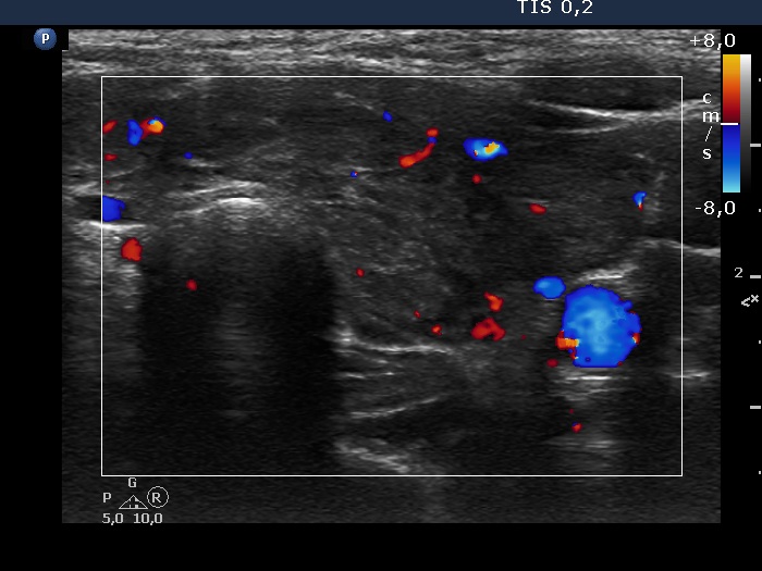Right lobe, longitudinal scan